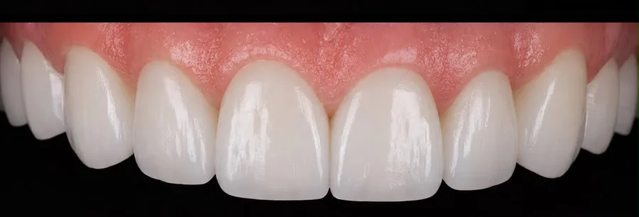 Porcelain veneer after photo, upper front teeth, case 7