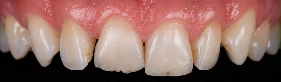 Porcelain veneer before photo, upper front teeth, case 7