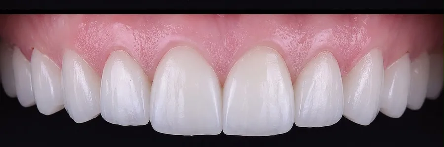 Porcelain veneer after photo, upper front teeth, case 8