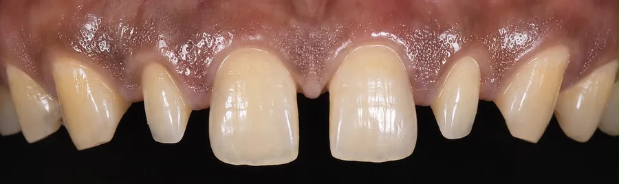Porcelain veneer before photo, upper front teeth, case 9