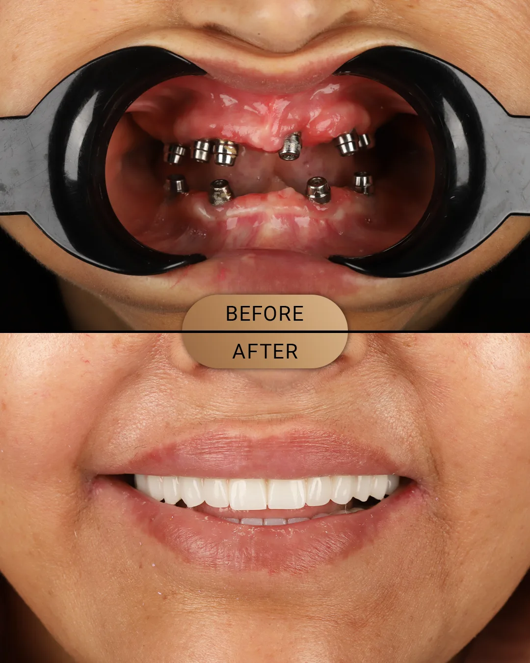 Full mouth implant before photo, case: All-on-6 Case