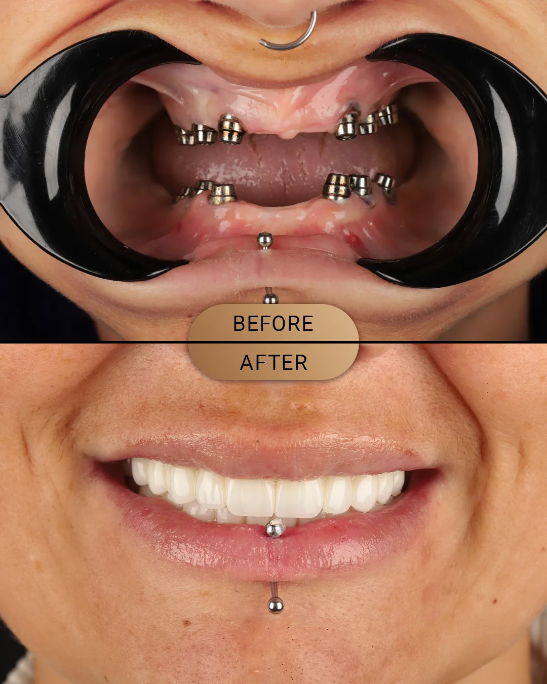 Full mouth implant before photo, case: All-on-6 Case