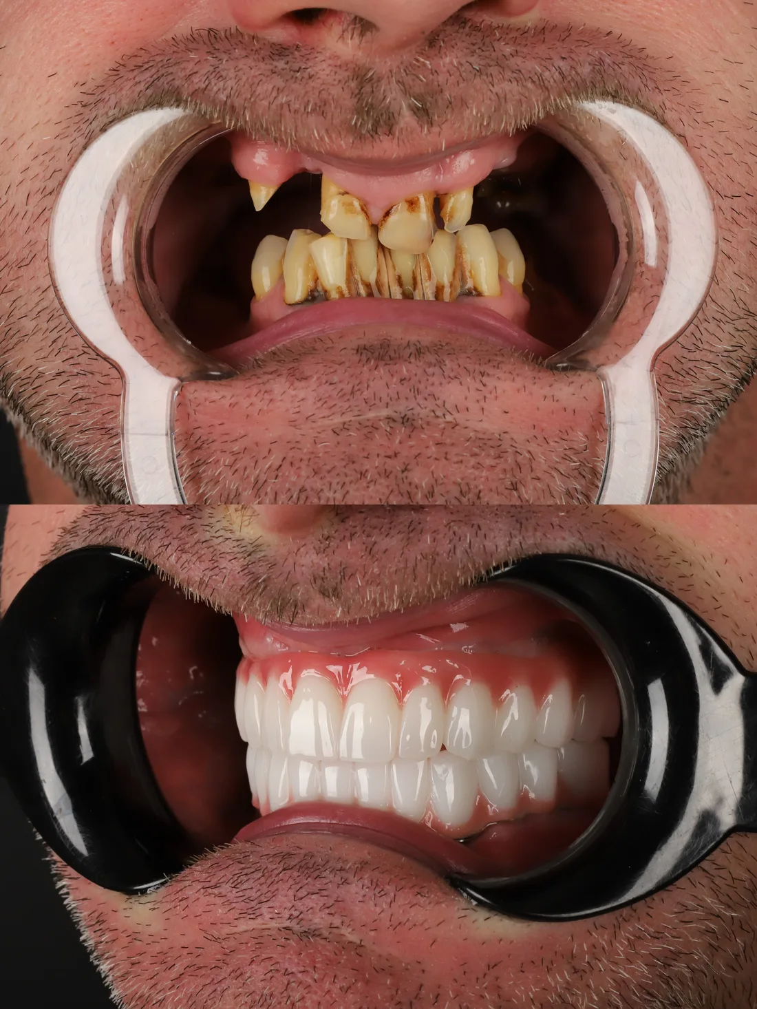 Full mouth implant before photo, case: All-on-6 Case