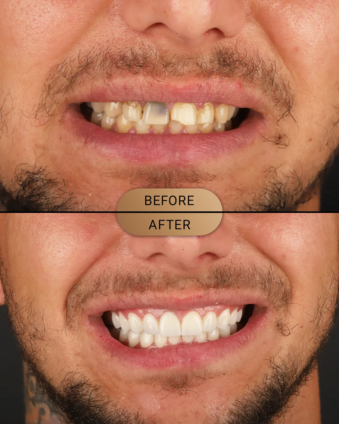 Zirconia crown before photo, case: Zirconia Case