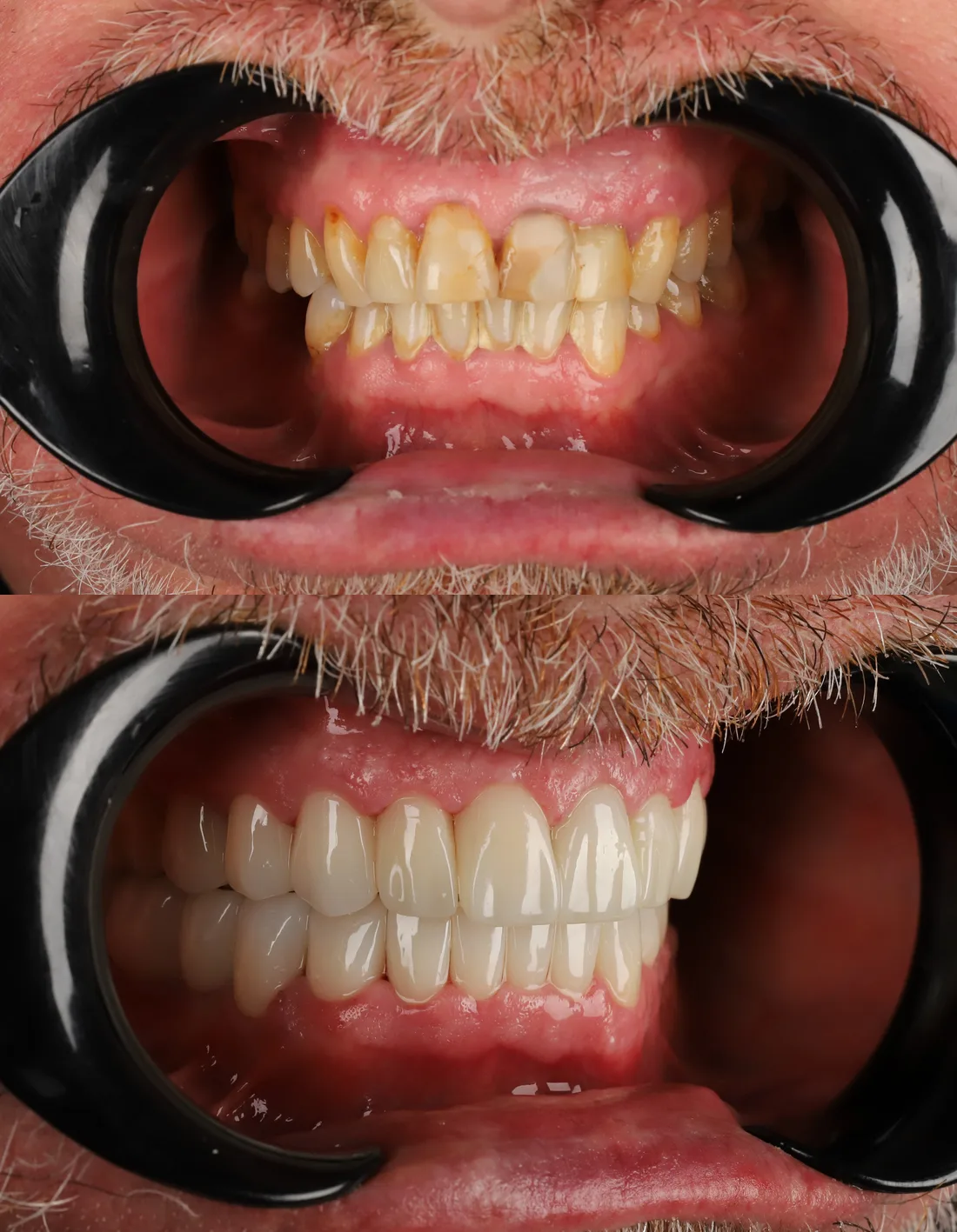 Zirconia crown before photo, case: Zirconia Case