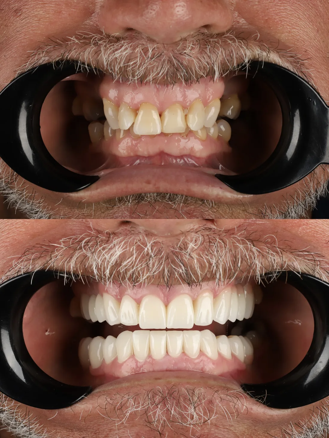 Zirconia crown before photo, case: Zirconia Case