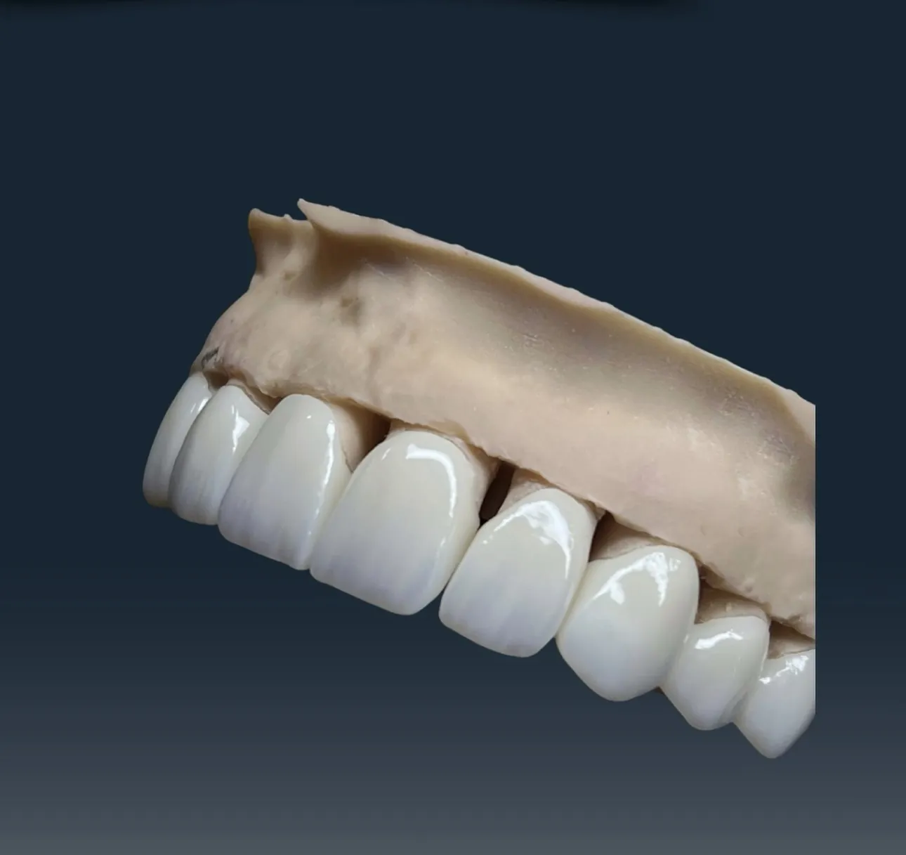 DentVisit — Ön grup kron, alçı model üzerinde katman detayı