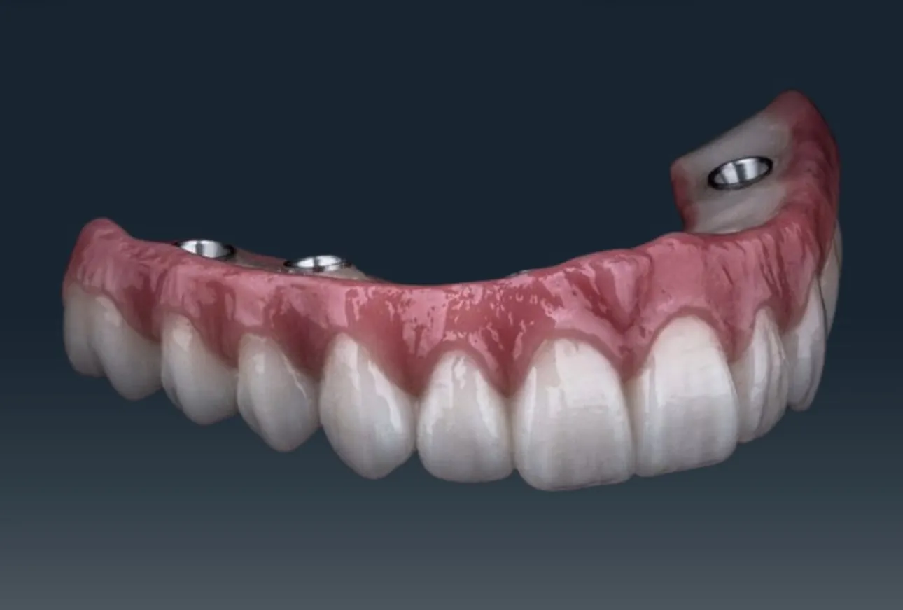 DentVisit — Tam ark protez, dişeti estetiği detayı