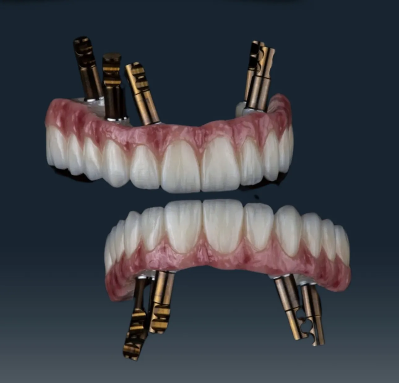DentVisit — Üst ve alt implant üstü tam ark protez