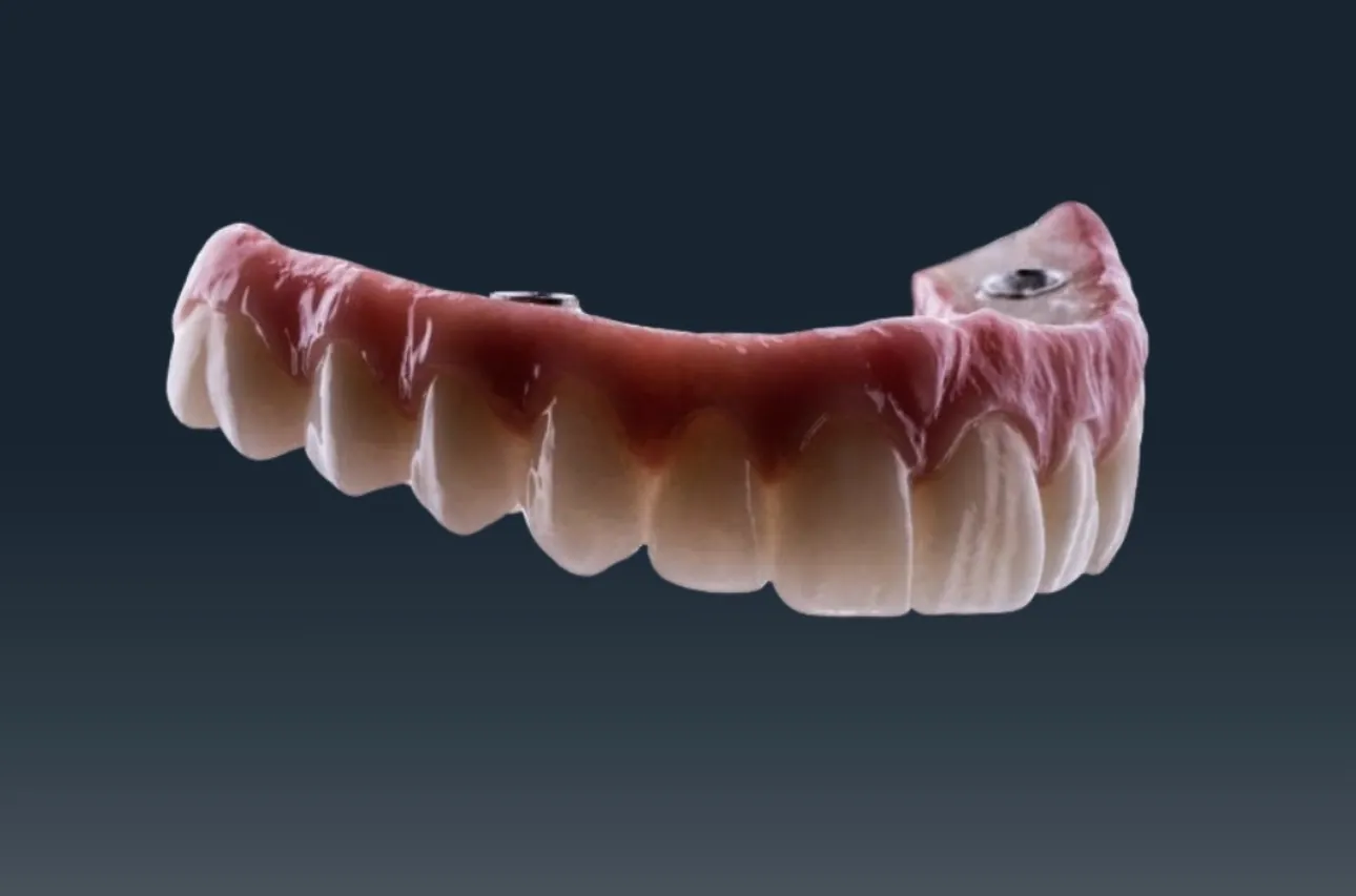 DentVisit — Tam ark protez, vida kanalı detayı