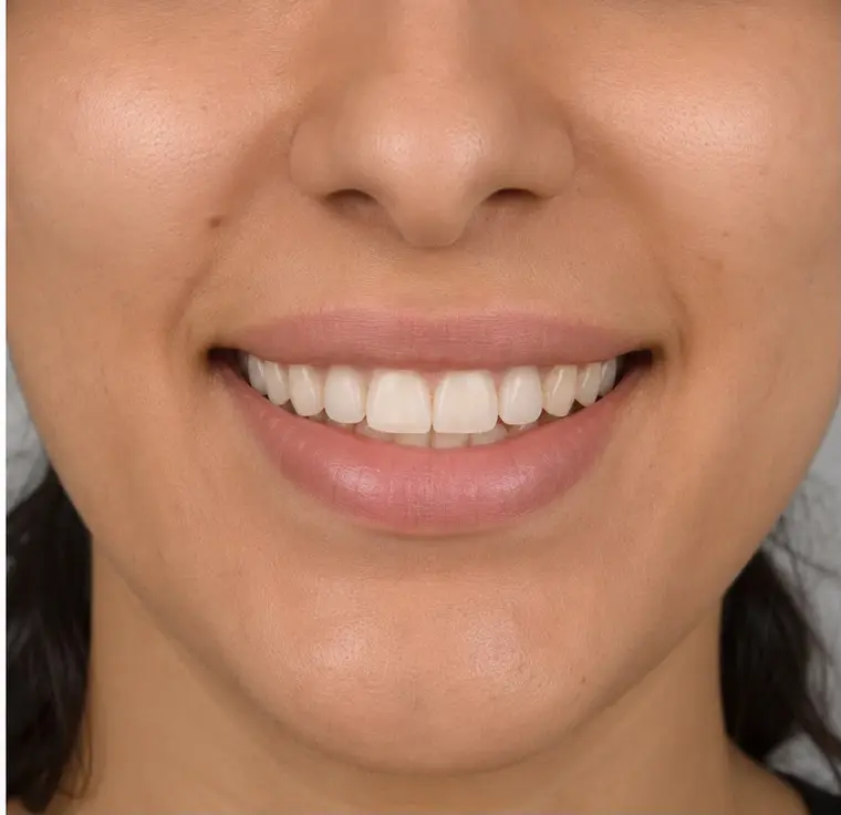 Close-up of a smile — who implant treatment suits