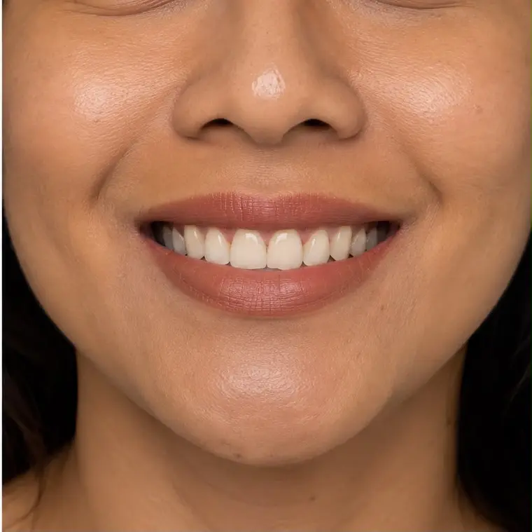Close-up of a smile — life after implant treatment