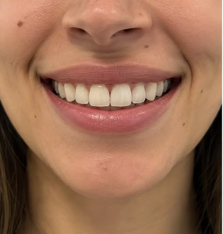 Close-up of a smile — orthodontic treatment options